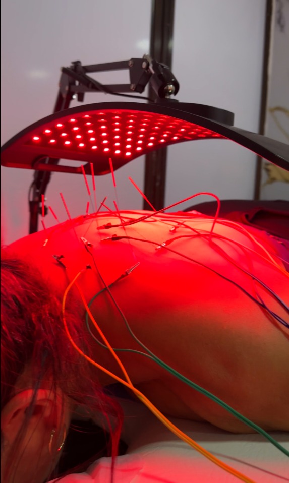 Electropunción con terapia de luz roja