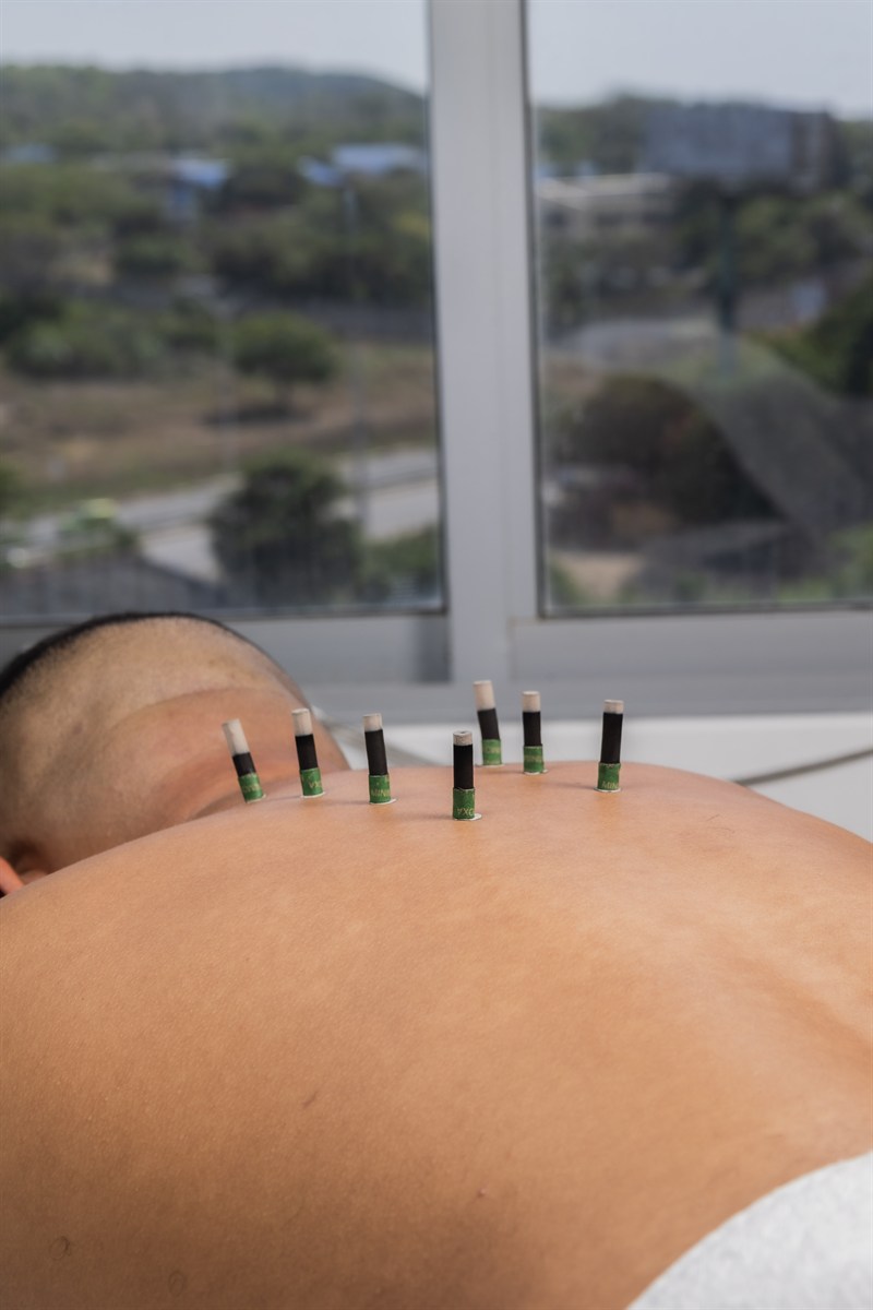Moxibustión y termoterapia bioenergética